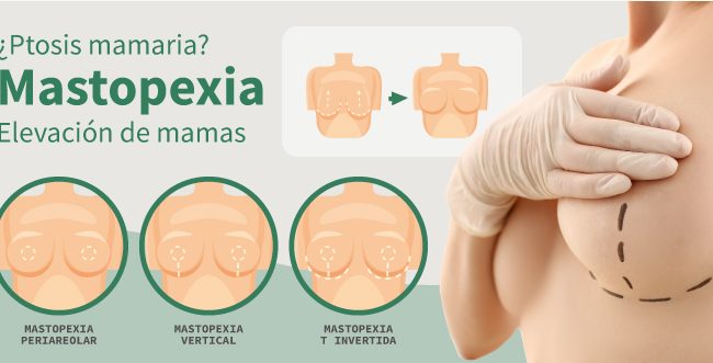 ¿Ptosis mamaria? Mastopexia y elevación de mamas