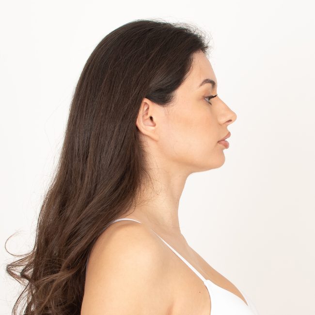 Rinoplastia y rinomodelación