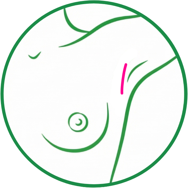Incision Axila