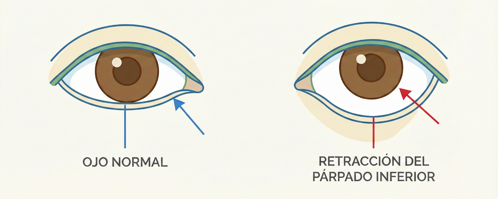 Ojo normal vs ojo con blefaroplastia mal hecha