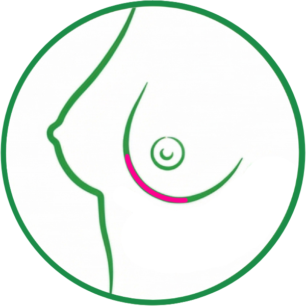 Incision Surco Submamario