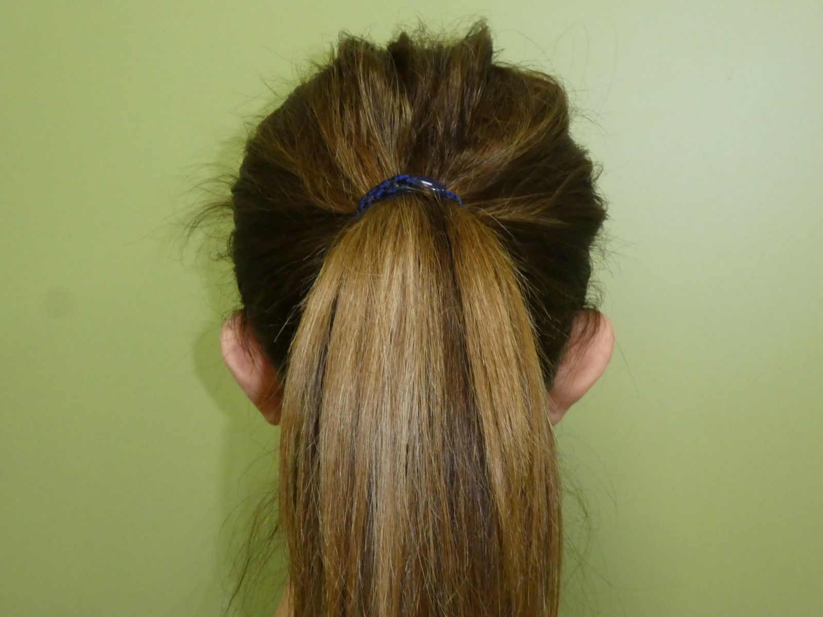 Otoplastia Caso 3 Antes