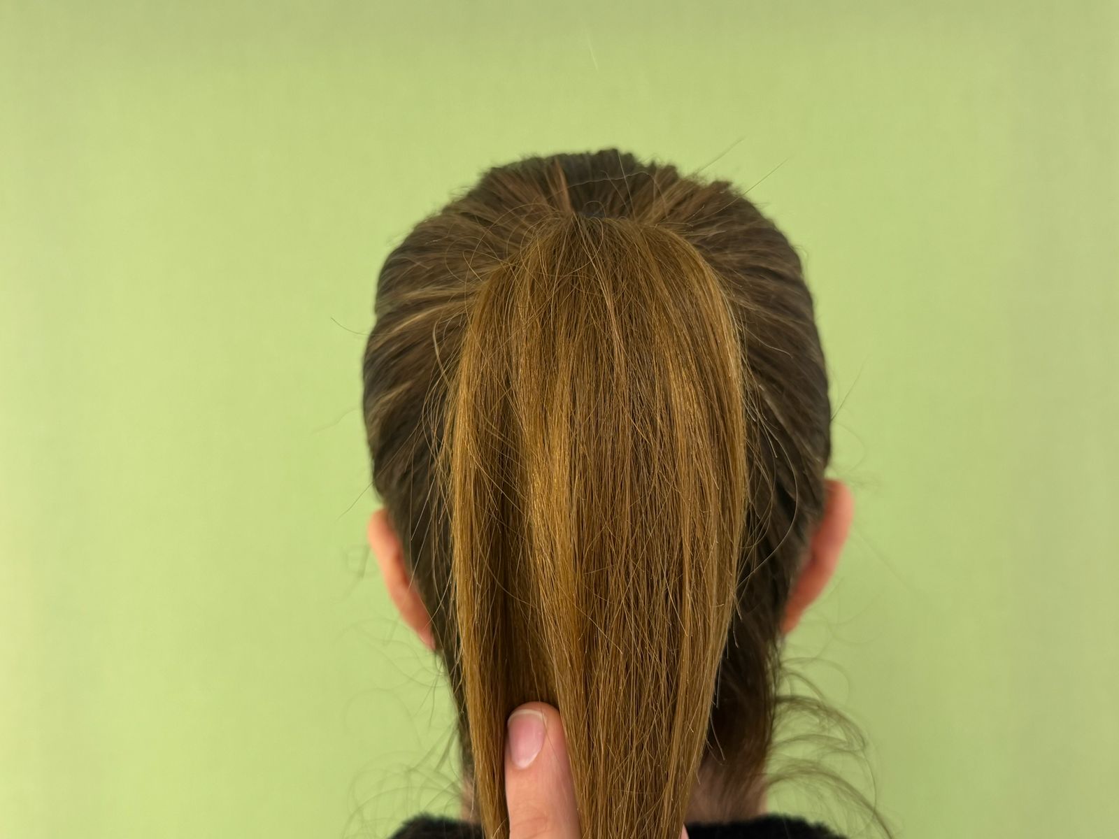 Otoplastia Caso 3 Después