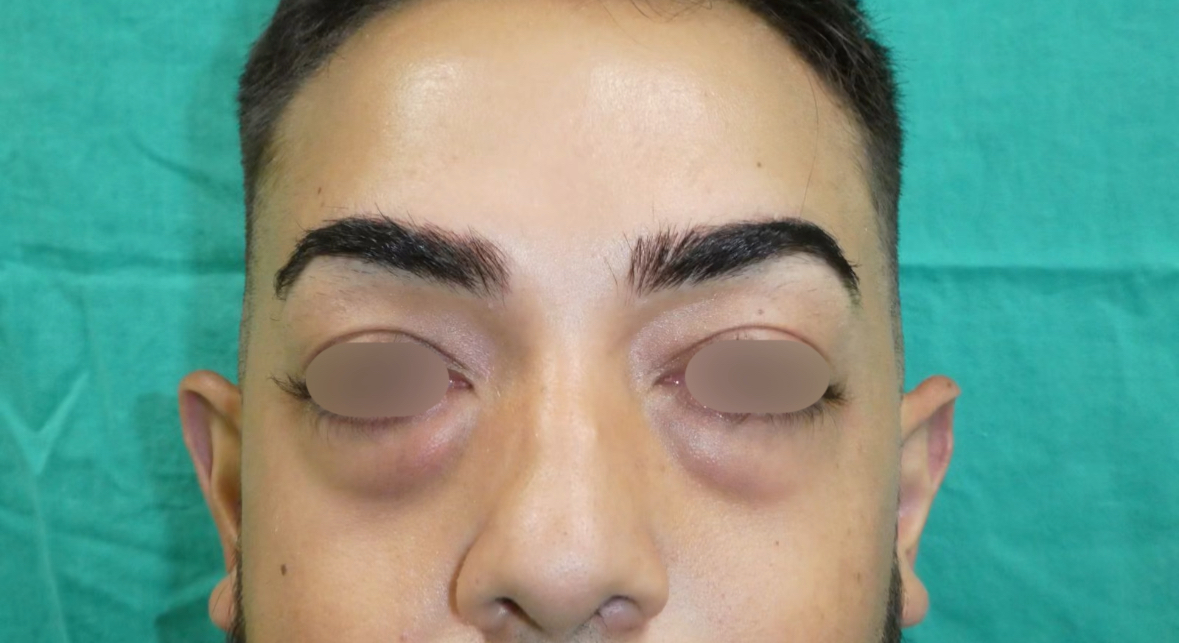 Blefaroplastia Caso 10 Antes
