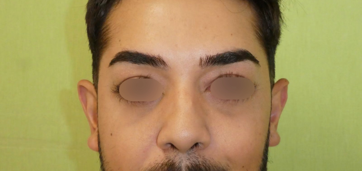 Blefaroplastia Caso 10 Después