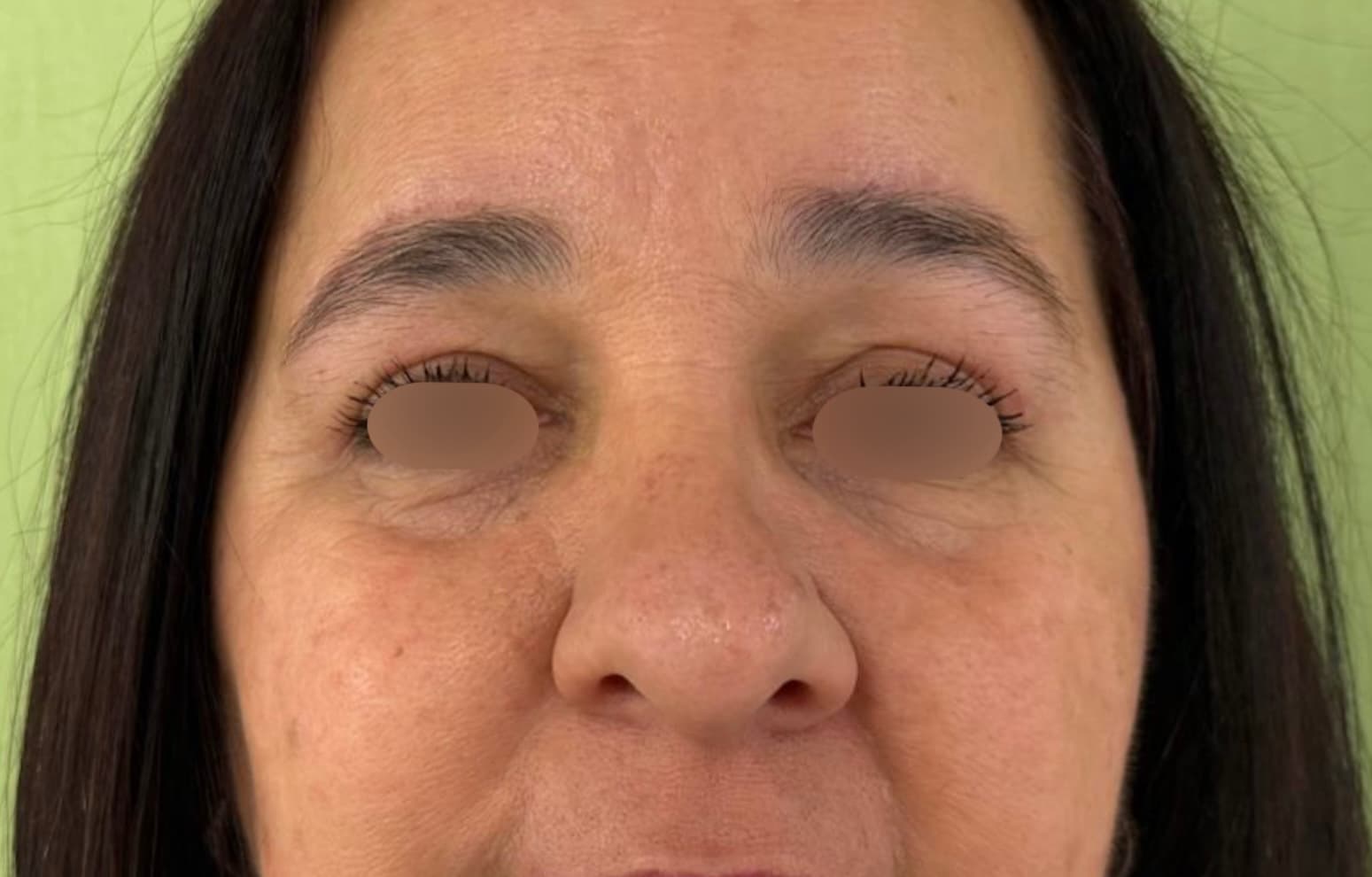 Blefaroplastia Caso 9 Después