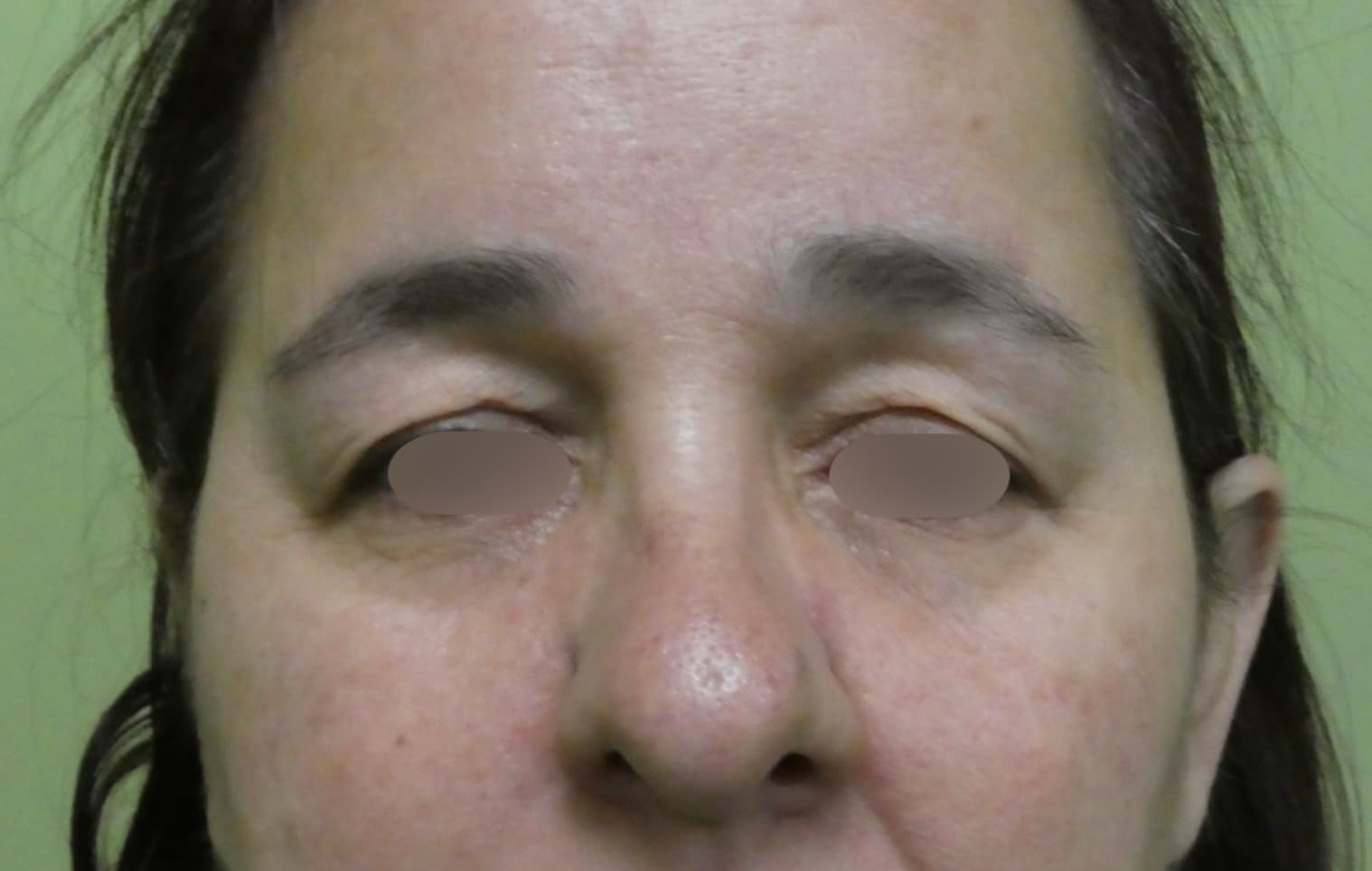 Blefaroplastia Caso 9 Antes