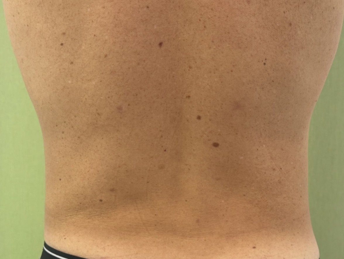 Liposucción caso 6 después