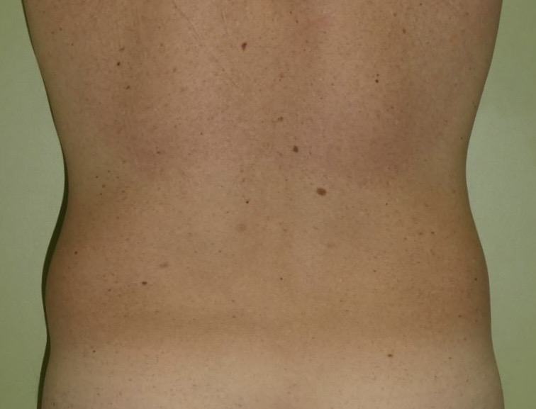 Liposucción caso 6 antes