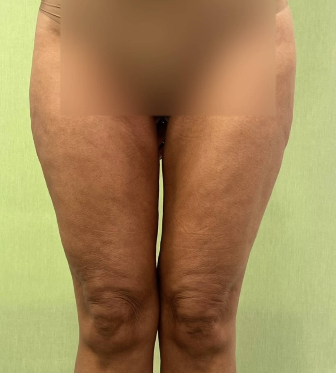 Liposucción caso 7 antes