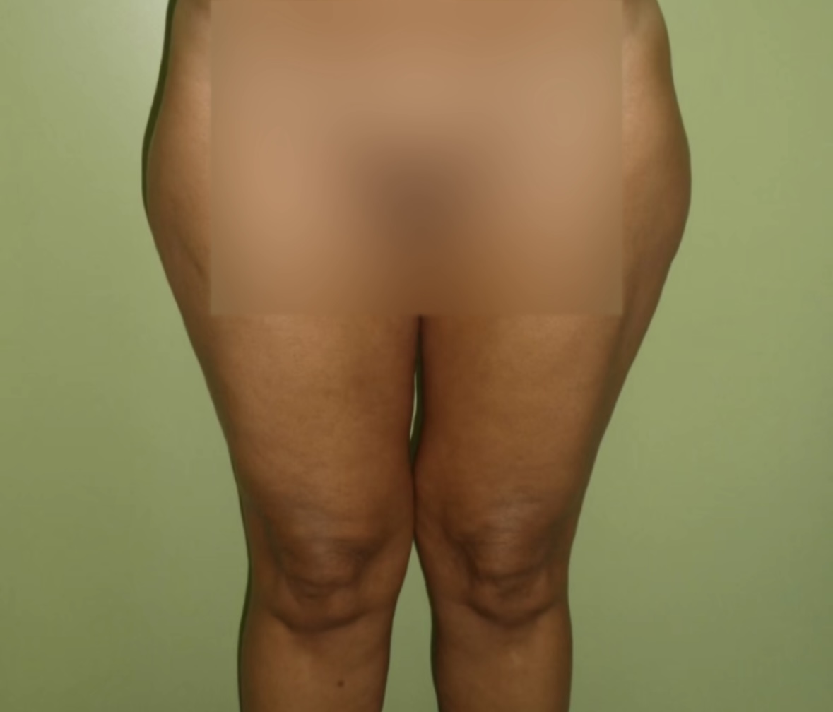 Liposucción caso 8 después