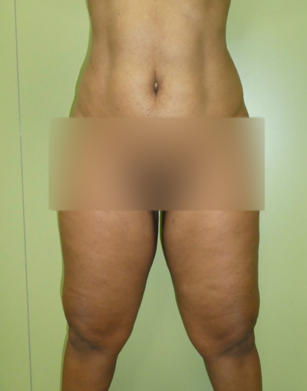 Liposucción caso 8 antes