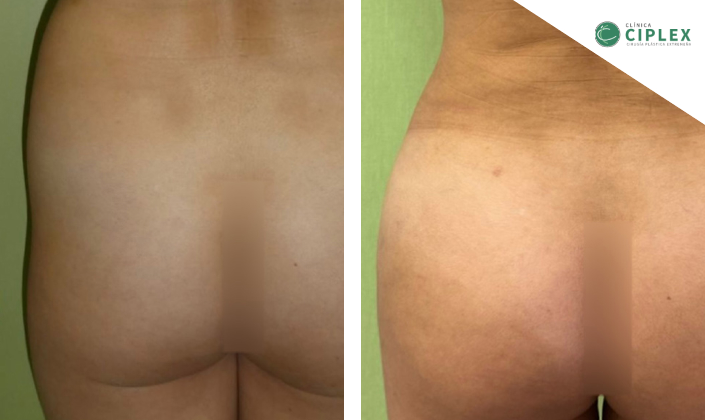 Liposucción antes y después — Clínica Cíplex